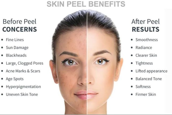 Peel chemical skin face peeling dark natural acne wrinkles make spots homemade treatment choose board using tips